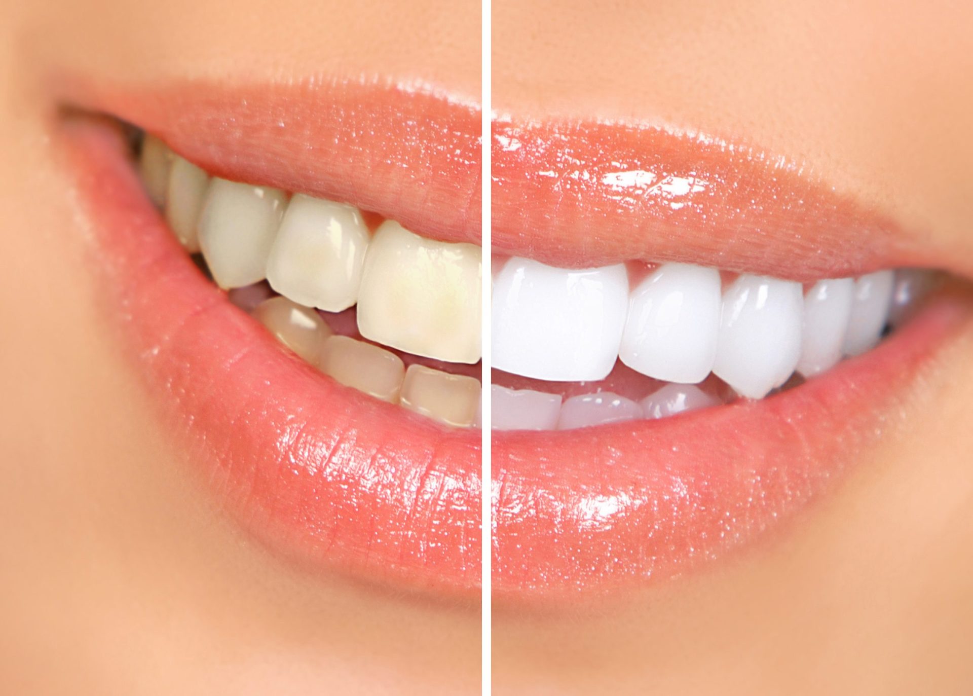 4 dicas para ter os dentes mais brancos