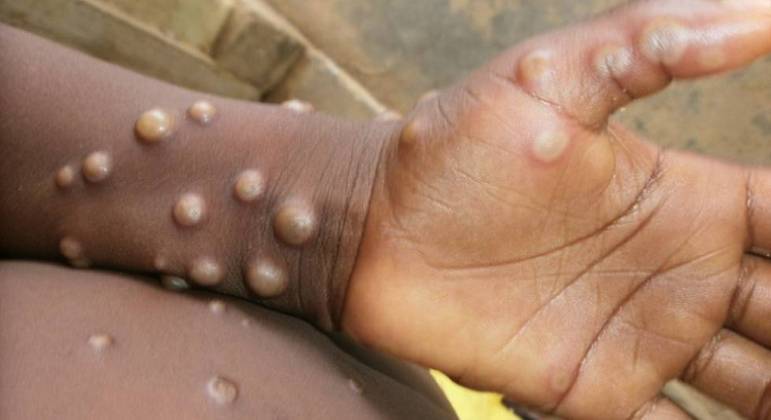 Monkeypox. OMS associa vírus a raves que aconteceram em Espanha e na Bélgica