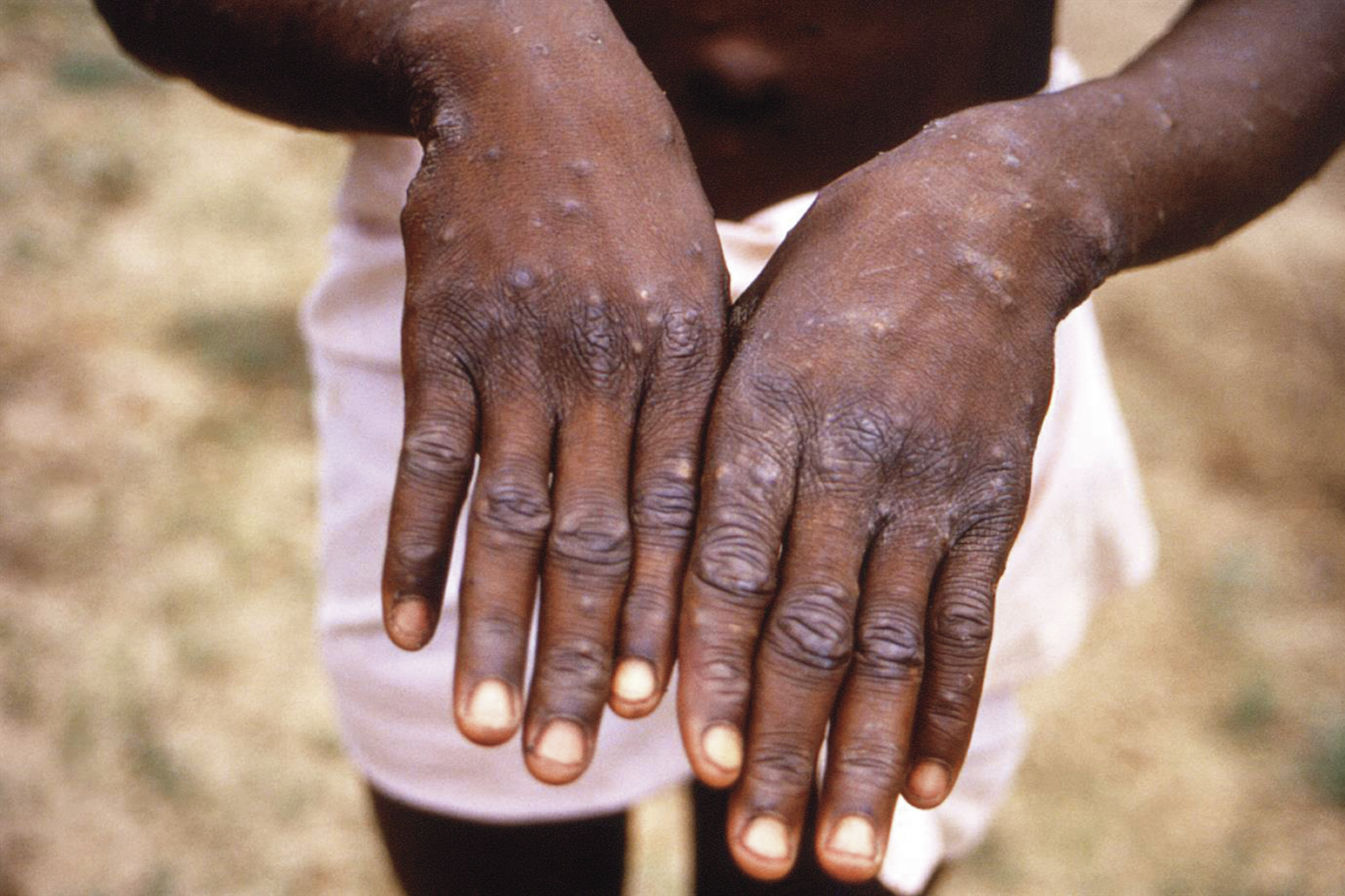 Monkeypox. OMS vai mudar nome e convoca comité de emergência