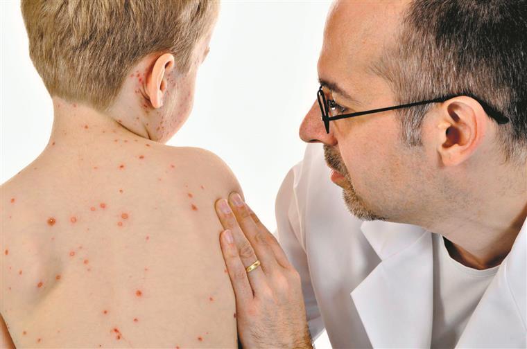 Sarampo. Mais seis casos confirmados no Hospital de Gaia