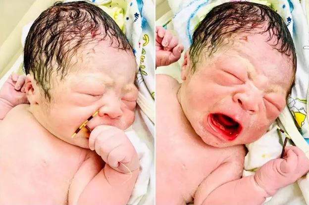 Imagens de bebé que nasceu a segurar o DIU da mãe tornam-se virais