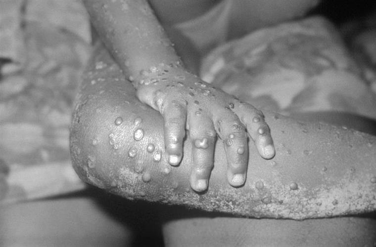 Infeções por Monkeypox em Portugal com tendência decrescente