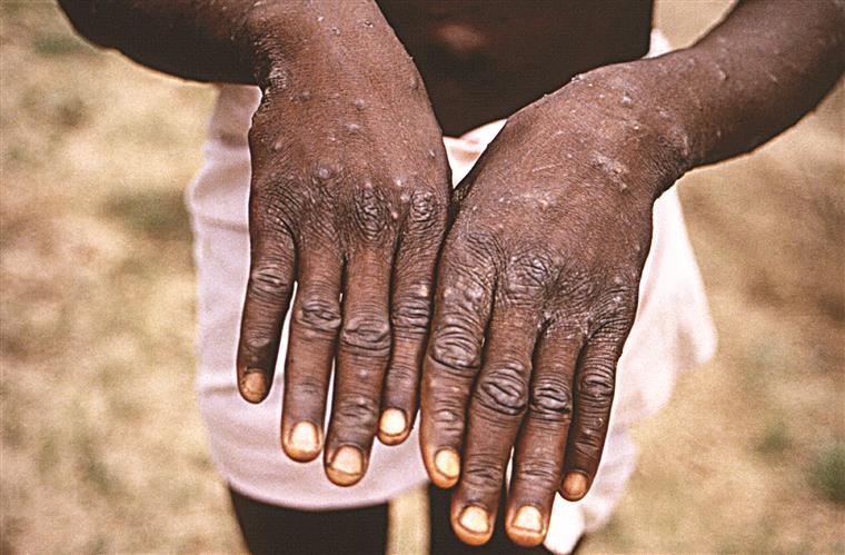 Monkeypox. Sobe para 328 o número de casos em Portugal