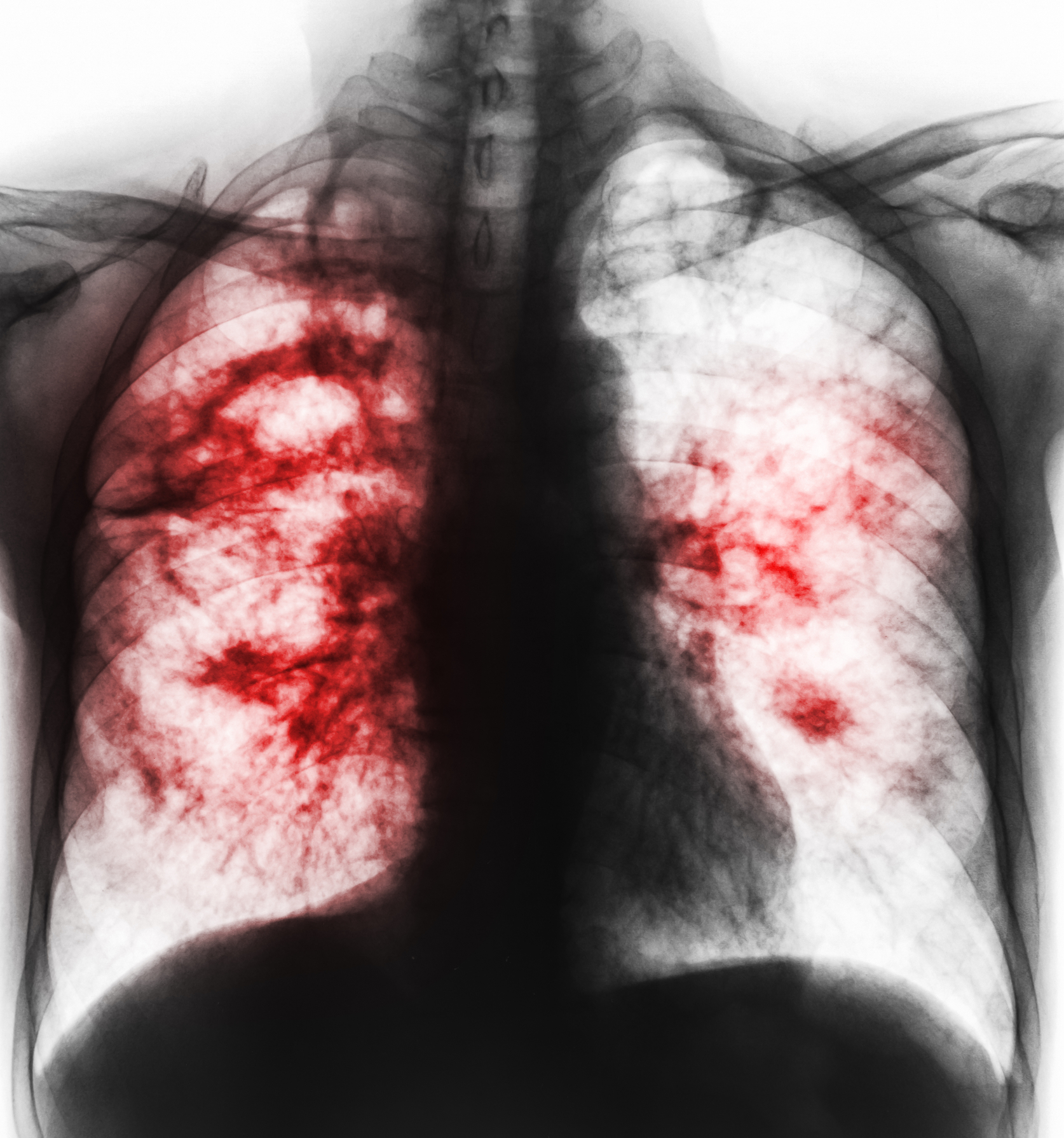 Mais 7.000 mortes do que expectável por tuberculose entre 2020 e 2022 na Europa