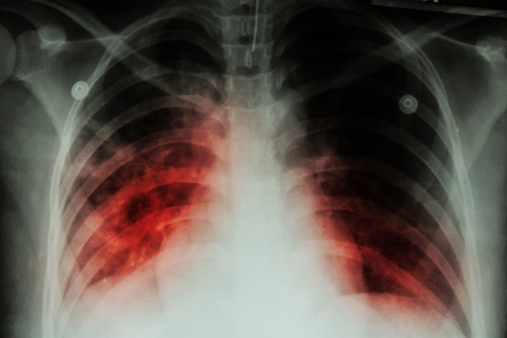 Tuberculose. Portugal com quase 1.600 casos de  em 2023